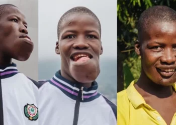 Sierra Leonean Man Gets Free Life-Changing Surgery to Remove Baseball-sized Tumor from his Jaw