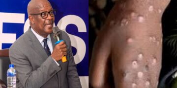 Health Minister Reveals Reason for Surge in Mpox Cases in Sierra Leone 