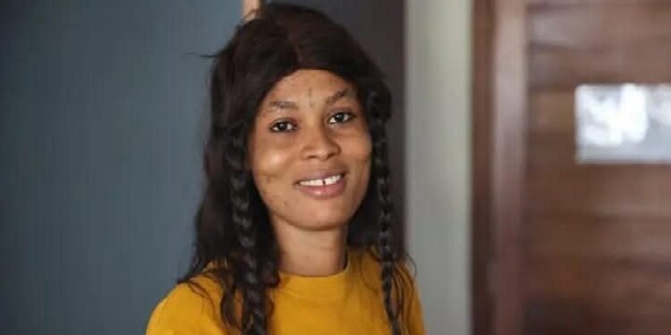 Monkeypox Is Real: The Heartbreaking Story of a Young Lady Who Passed Away from the Virus