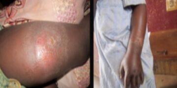 Sierra Leone Government Confirms Skin Ulcer Outbreak in Bombali District