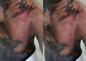 Man Seriously Burned in Kenema After Theft Allegation