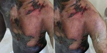 Man Seriously Burned in Kenema After Theft Allegation