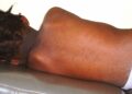 National Public Health Agency Warns of Measles Outbreak in Sierra Leone