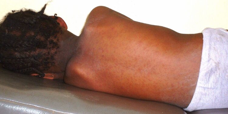 National Public Health Agency Warns of Measles Outbreak in Sierra Leone